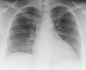 Chest Xray