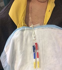 Permcatheter 2