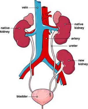 Transplant Diagram