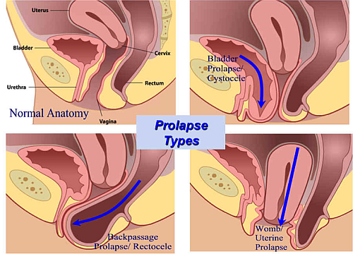 Image result for uterine prolapse cystocele