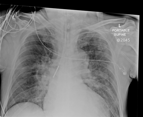 Proximal Right Main Bronchus