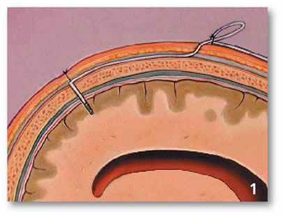 Intraparenchymal