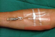 PICC line
