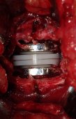 Shot of the complete artificial disc replacement inside a patient. 