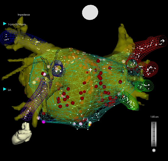 view areas in the heart that cause atrial fibrillation, or irregular heart rhythm