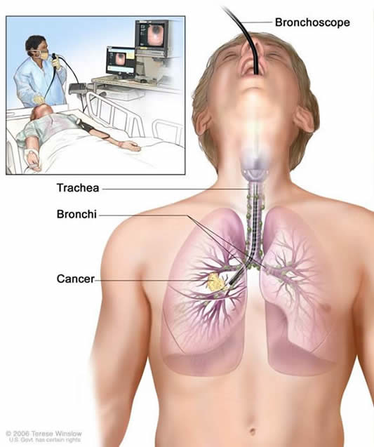 Bronchoscopy