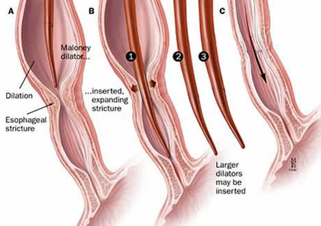 Dilation