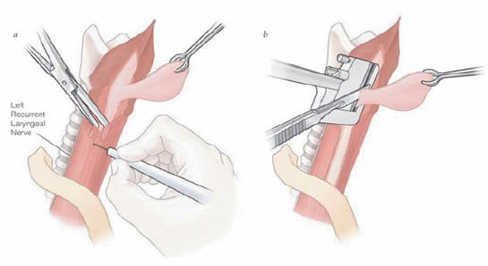 Diverticulectomy