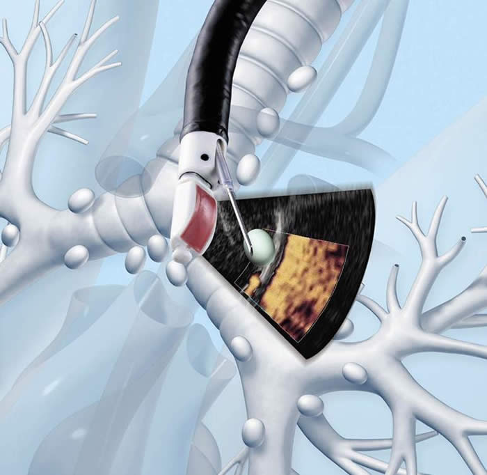 Endobronchial Ultrasound (EBUS) | LHSC