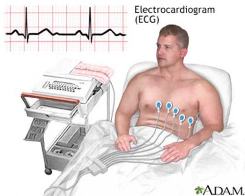 Elektrokardiogrammit (EKG)