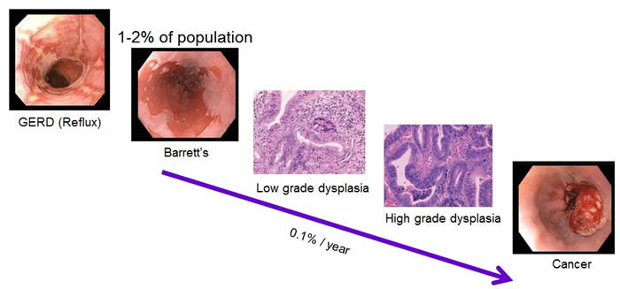 Barretts to Cancer