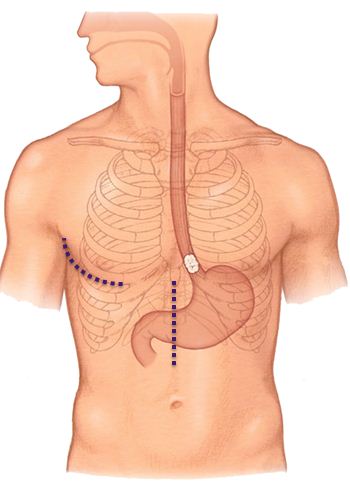 Open Esophagectomy