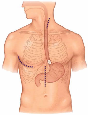 Esophagectomy Open