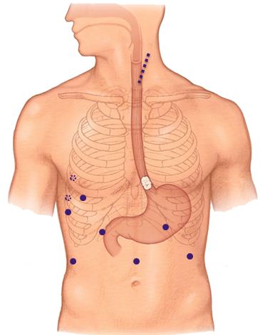 Esophagectomy VATS