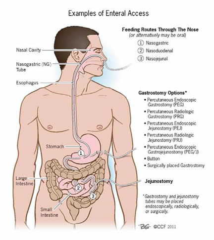 Feeding Tubes