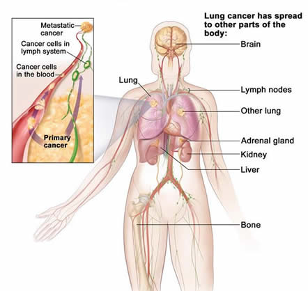 Lung Stage IV