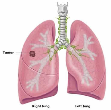 Lung Stage I