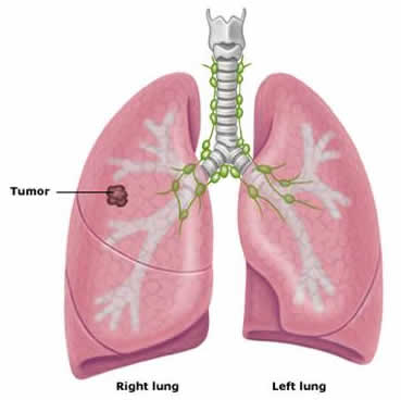 Lung Stage I