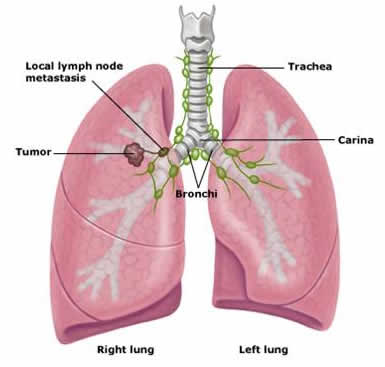 Lung Stage II