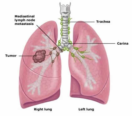 Lung Stage III