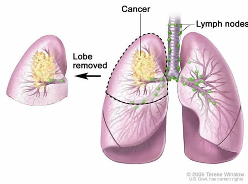 Lung Surgery Lobectomy