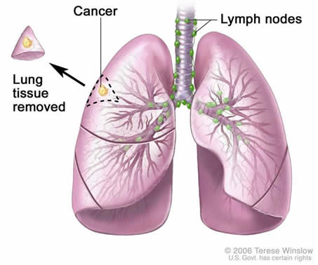 Lung Surgery Wedge