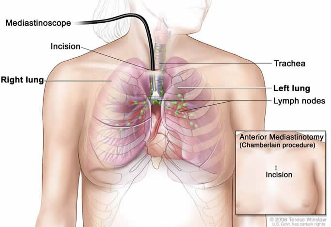 Mediastinoscopy