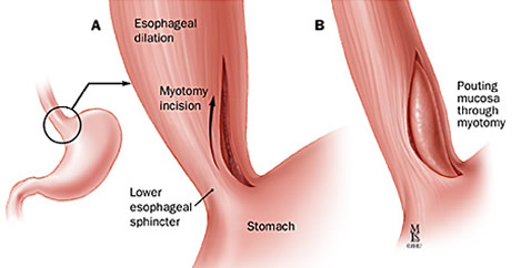Myotomy