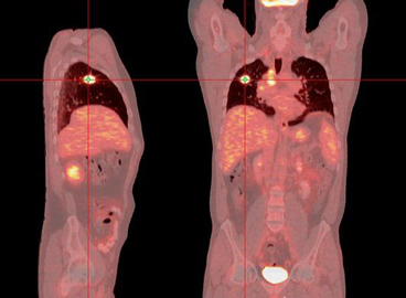 Positron Emission Scan (PET Scan)