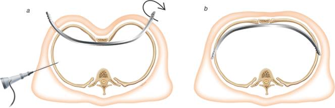 Pectus