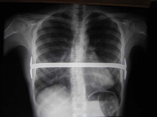 Pectus