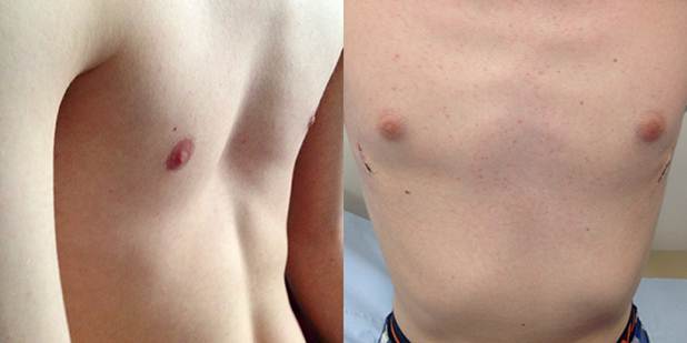 Pectus Before and After