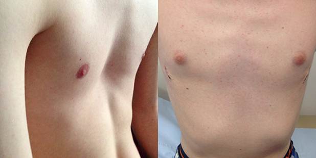 Pectus Before and After