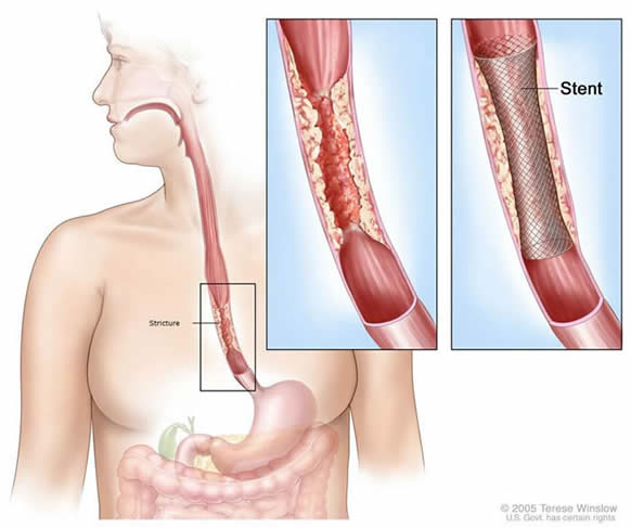 Stents
