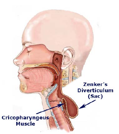 Zenkers
