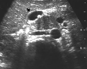 Abdominal Ultrasound