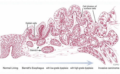 Barretts to cancer cells
