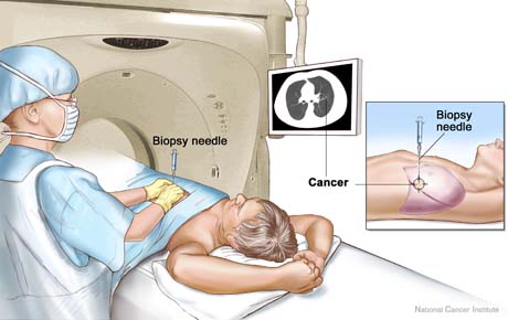 biopsy