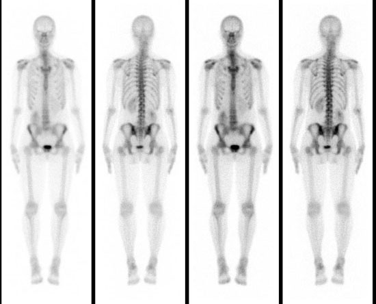 bone scan image