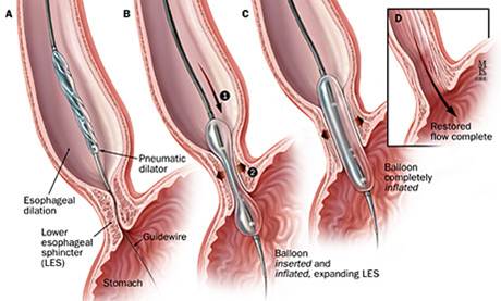 Dilation