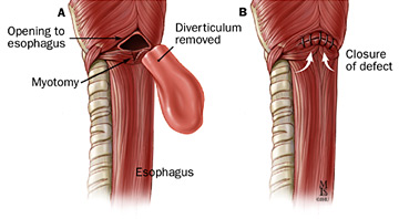 Diverticulectomy