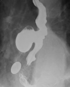 Diverticulum - Barium Swallow