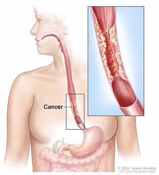 esophageal cancer