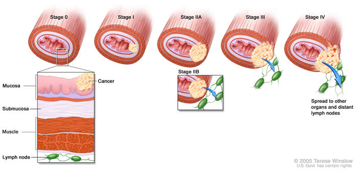 Esophageal Cancer Staging
