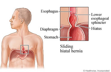 Hiatal Hernia and Anti-Reflux Surgery | LHSC upper esophageal sphincter diagram 