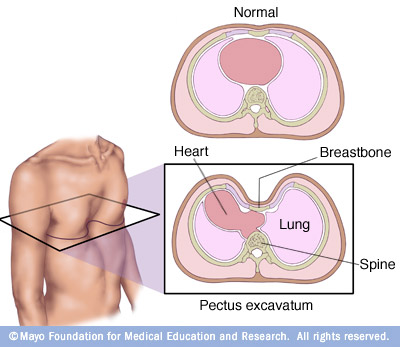 Pectus