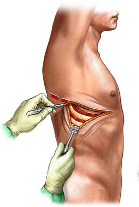 Thoracotomy