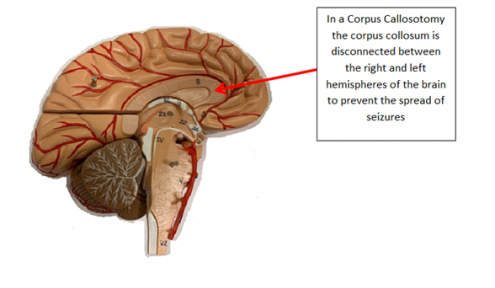 Corpus Callostomy