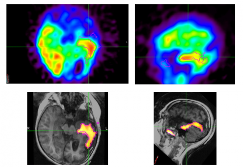 SPECT Scan Images