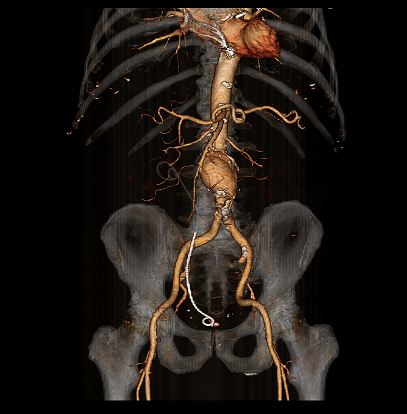 Mr. Barker's EVAR x-ray.